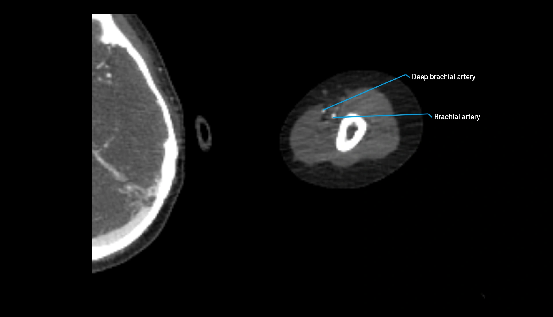CTA upper limb axial cross sectional anatomy labelled image 252 (2).webp